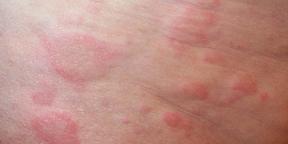 Οι αλλεργίες στο παιδί: ό, τι οι γονείς πρέπει να ξέρετε για τη διάγνωση και τη θεραπεία