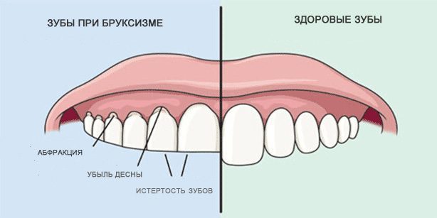 Τρίξιμο των δοντιών: Υγιή δόντια και τα δόντια κατά τη διάρκεια της βρουξισμός