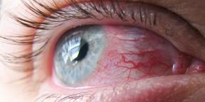 Επιπεφυκίτιδα: γιατί κοκκινίζουν τα μάτια και πώς να τους αντιμετωπίσουμε