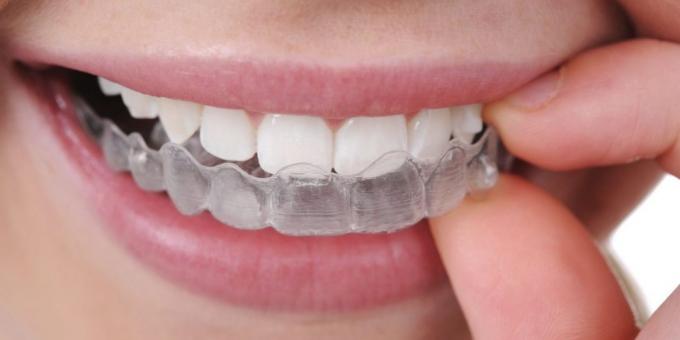 Δόντια άλεση: προστατευτικό κάλυμμα