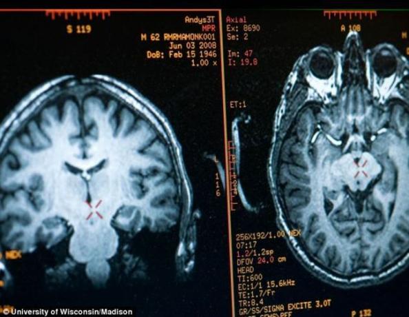 εγκεφάλου Mathieu Ricard εικόνα που λαμβάνεται με MRI