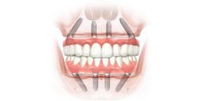 Πώς να αποκαταστήσει τα δόντια σας και το χαμόγελο πίσω