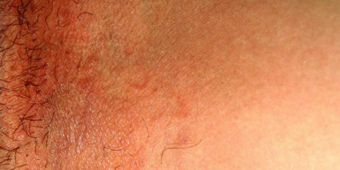 Inguinal ringworm