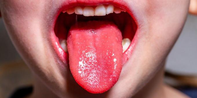 Συμπτώματα ερυθρού πυρετού: Γλώσσα φράουλας