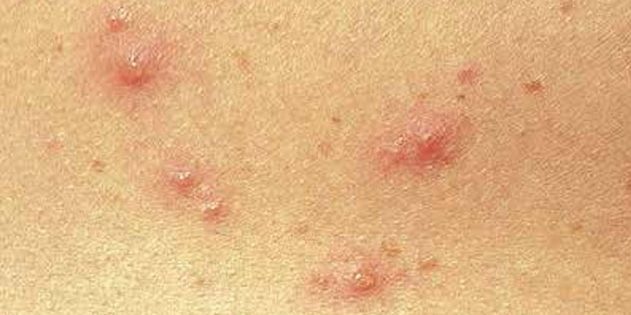 Τα συμπτώματα της ανεμοβλογιάς σε παιδιά και ενήλικες: Αρκετά συχνά, το δέρμα φαίνεται αμέσως μικρές κόκκινες κουκίδες